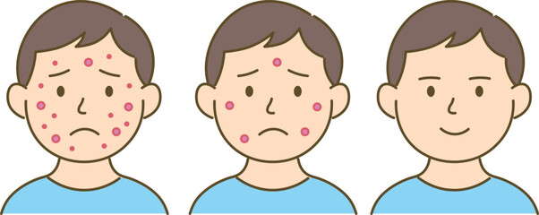 Before and After Acne Improvement – Step-by-Step Illustration
