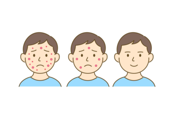 Before and After Acne Improvement – Step-by-Step Illustration