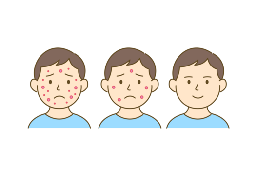 Before and After Acne Improvement – Step-by-Step Illustration