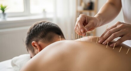 Obraz premium Acupuncture treatment being performed on a patient's back for pain relief