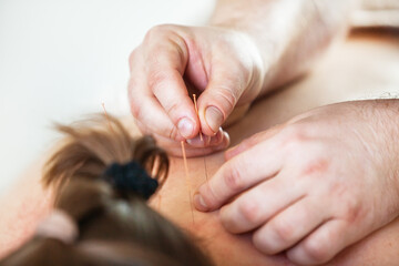 Chinese medicine. Close-up of a doctor's hands doing acupuncture