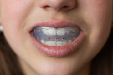 Fototapeta premium A child or girl or young woman holds a silicone orthodontic cap in her mouth to straighten her teeth. Front view close-up