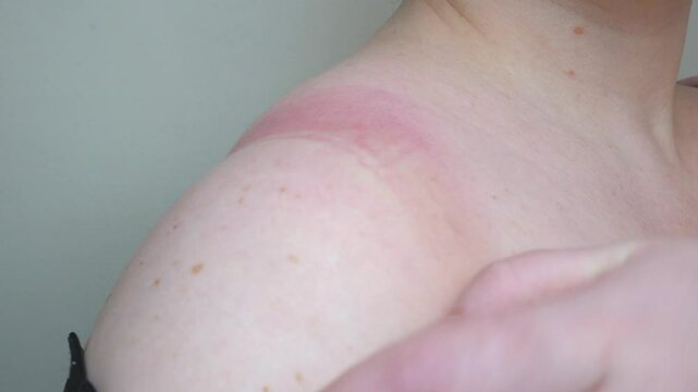 A red stripe from a bra on a woman's shoulder.
A close-up of the shoulder skin with a noticeable red spot from the bra, caused by the pressure of the fabric. The woman's hand touches the redness.