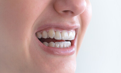 Obraz premium Boca de mujer con placas termoplásticas removibles para contención dental de ortodoncia. 