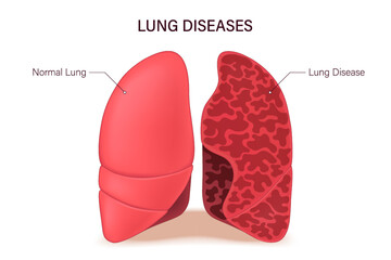 Lung diseases. Lungs anatomy. Normal lung and lung disease. Human respiratory system.