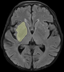 the distributions of cerebral blood vessels.