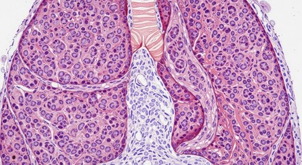 Detailed Lung Tissue Illustrating Pneumonia Infection Pathology
