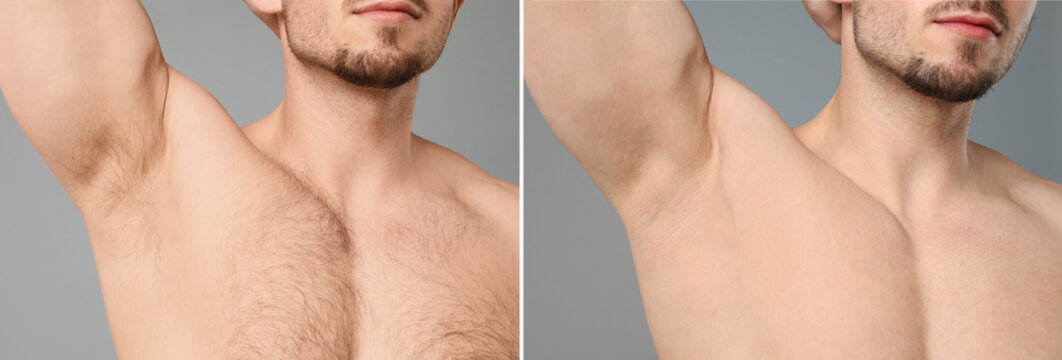 Before and after epilation. Collage with photos of man showing armpit and chest on grey background, closeup