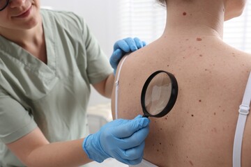 Doctor examining woman's moles in hospital, closeup