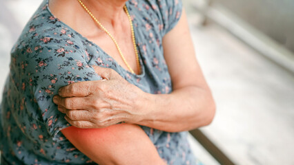 Close up of elderly woman holding painful swollen upper arm with redness on skin showing signs of...