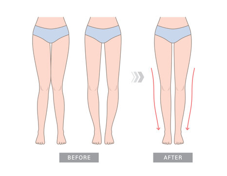 Knock knees, bow legs and normal legs. Knee valgus deformities. Healthy joint, knock-knee and Bow-leggedness. Corrective surgery