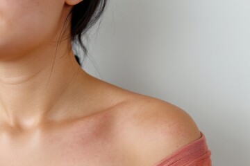 This Macro View Provides a Detailed Examination of an Allergic Rash That is Characterized by Prominent Red Patches Located on the Upper Arm and Shoulder Area of an Individual