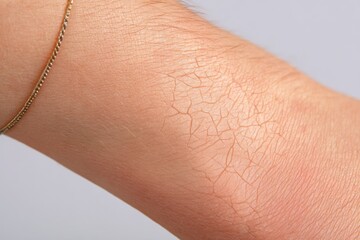 Exploring the Intricate Details of Dry Elbow Skin Showcasing a Cracked Texture, Revealing the Effects of Environmental Conditions on the Skin's Surface and Highlighting the Need for Hydration