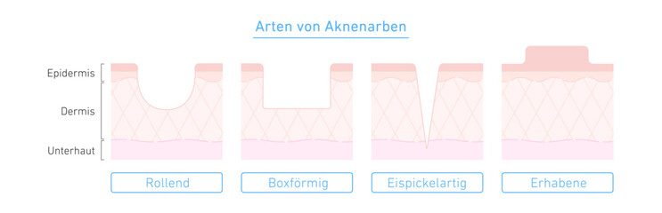 Arten von Aknenarben mit Hautquerschnitt – anschauliche Illustration