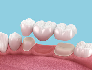 Dental bridge of 3 teeth over molar and premolar. Medically accurate 3D illustration of human teeth treatment