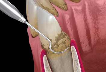 Fototapeta na wymiar Oral hygiene: Scaling and root planing of Periodontitis (conventional periodontal therapy). 3D illustration