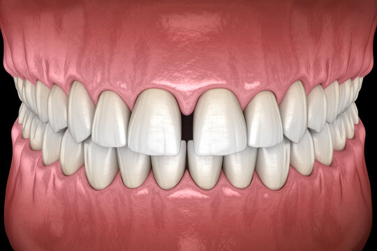 Diastema of central incisors teeth. Dental disfunction 3D illustration concept