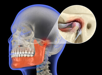 Plakat Temporomandibular joints arthritis and dislocated articular disc. Medical 3D illustration.