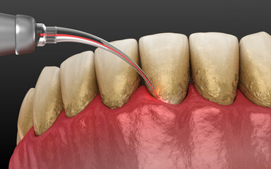 Fototapeta na wymiar Laser removes tartar and thin layer of infected skin, teeth cleaning. Dental 3D illustration