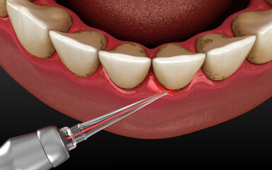 Laser removes tartar and thin layer of infected skin, teeth cleaning. Dental 3D illustration