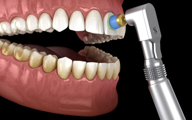 Teeth polishing procedure with professional brush and gel. 3D illustration