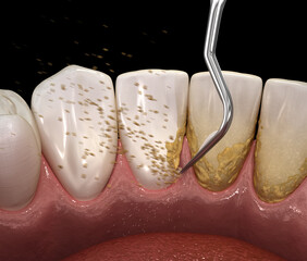 Oral hygiene: Ultrasonic teeth cleaning machine removing calculus and plaque. 3D illustration