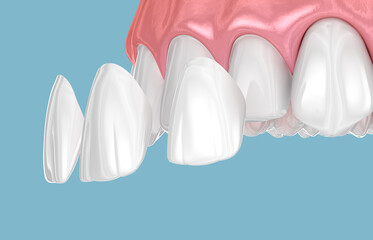 Dental veneer placement over frontal teeth. 3D illustration