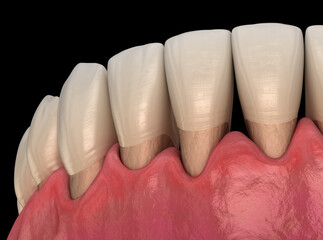 Gingivitis inflammation of the gums. Dental 3D illustration