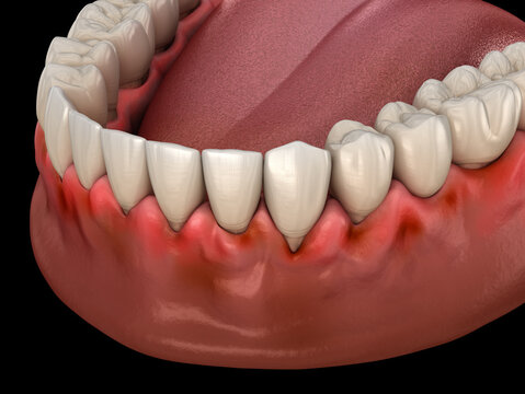 Gingivitis inflammation of the gums. Dental 3D illustration