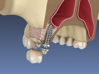Sinus Lift Surgery - implant installation. 3D illustration © Alex Mit