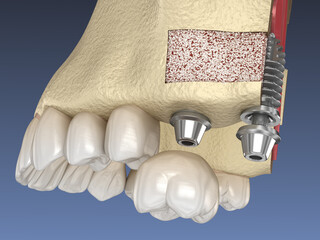 Sinus Lift Surgery - implant installation. 3D illustration © Alex Mit