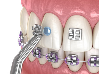 Metal braces installation process. Dental 3D illustration