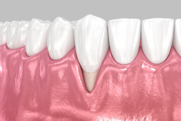 Gum Recession: Soft tissue moving down. Dental 3D illustration