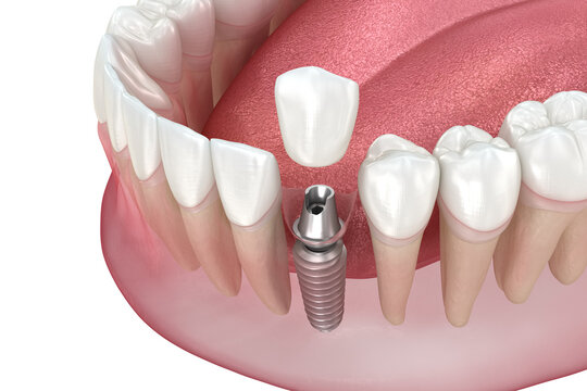 Premolar tooth recovery with single implant. 3D illustration of human teeth and dentures