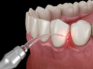 Fototapeta na wymiar Gum correction surgery with laser. Dental 3D illustration