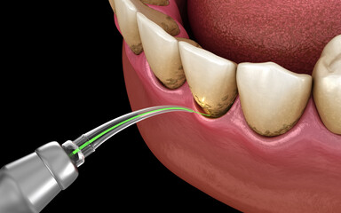 Gum correction surgery with laser. Dental 3D illustration