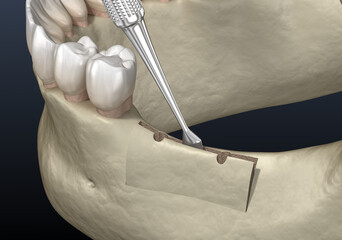 Cleavage of the alveolar ridge. Dental surgery, 3D illustration