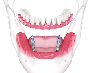 Obraz na płótnie Canvas Mandibular removable prosthesis All on 2 system supported by implants with ball attachments. Medically accurate dental 3D illustration
