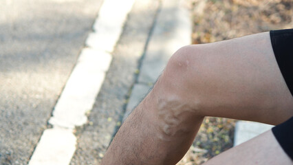 Varicose veins on the legs of men