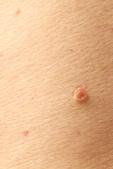 Man with mole on his skin, closeup