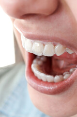 Apertura bucal con retenedores dentales removibles. Etapa o fase final de tratamiento de...