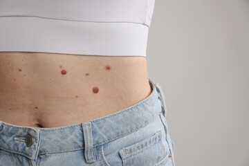 Woman with moles on her body against light background, closeup