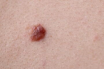Woman with mole on her body, closeup