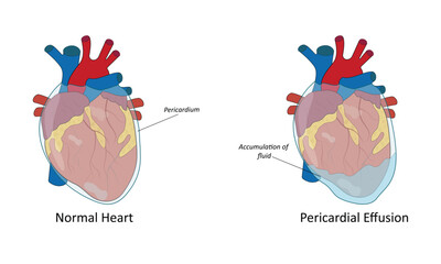 Pericardial effusion vector illustration