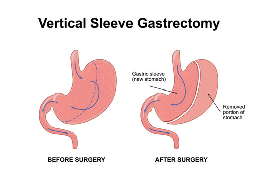 Vertical sleeve gastrectomy. Distended stomach surgery, gastroenterology operation. Weight loss procedure, limiting the size of the stomach. Flat vector illustration
