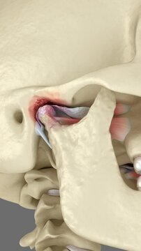 Temporomandibular joints arthritis and dislocated articular disc. Dental 3D animation
