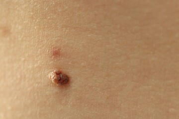 Woman with mole on her skin, closeup