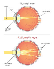 Astigmatism medical diagram. Normal eye and astigmatic eye.Vector illustration. 