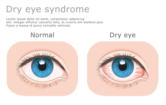 Dry eye medical illustration. Normal eye and dry eye.Vector illustration. 