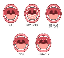 口腔内にできる症状のイラストセット